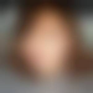 arcypodaktyzm
